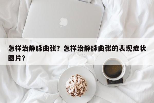 怎样治静脉曲张？怎样治静脉曲张的表现症状图片？-第3张图片-890百科网